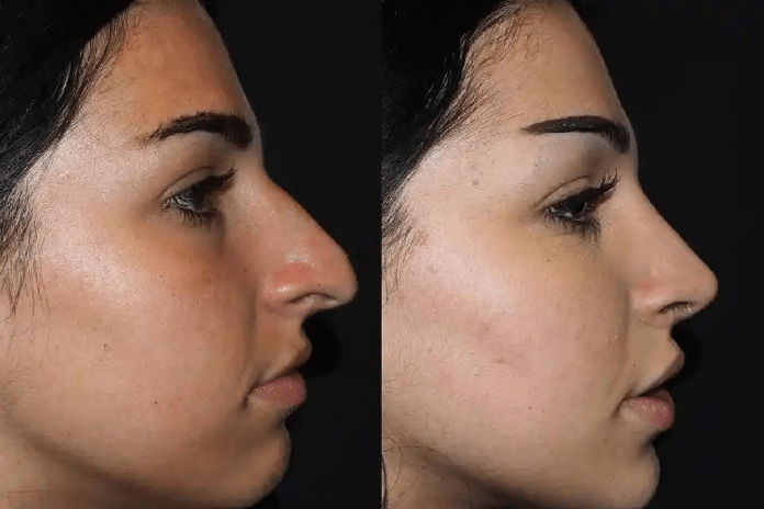 Enhancing Confidence The Psychological Impact of Rhinoplasty in Dubai