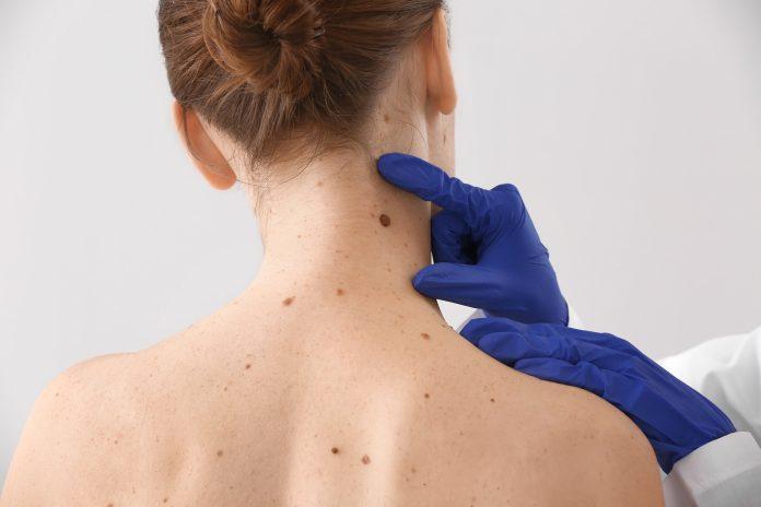 Skin Lesion Removal Treatment in Dubai