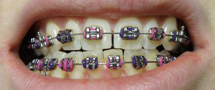 dental braces Thousand Oaks CA