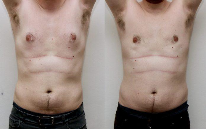 gynecomastia surgery in dubai