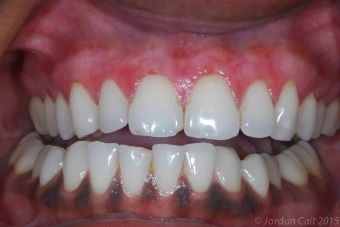 gum depigmentation near me