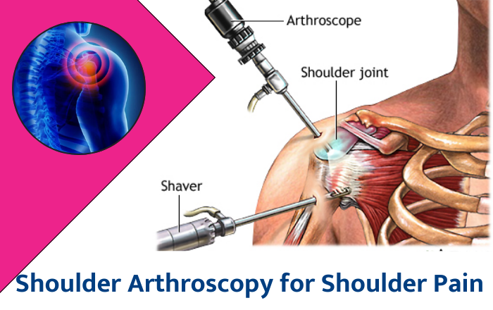 Shoulder arthroscopy surgery