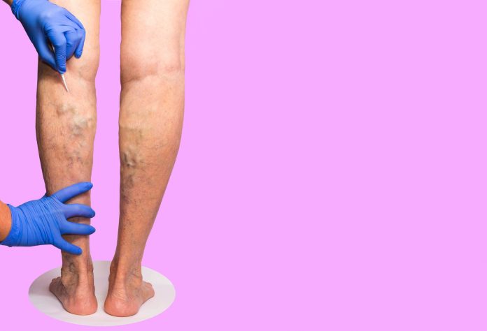 What Kind of Doctor Treats Varicose Veins