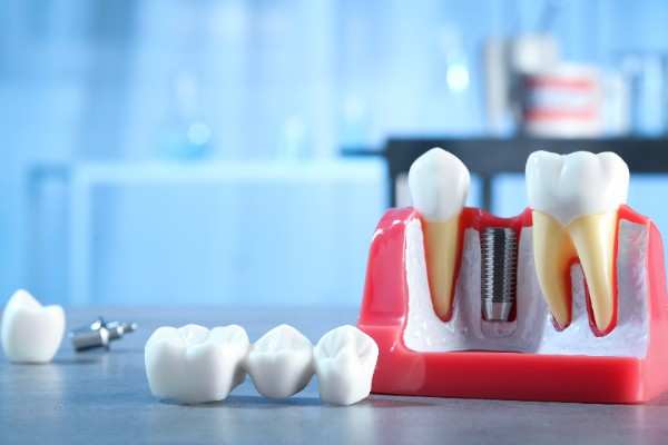 dental implant