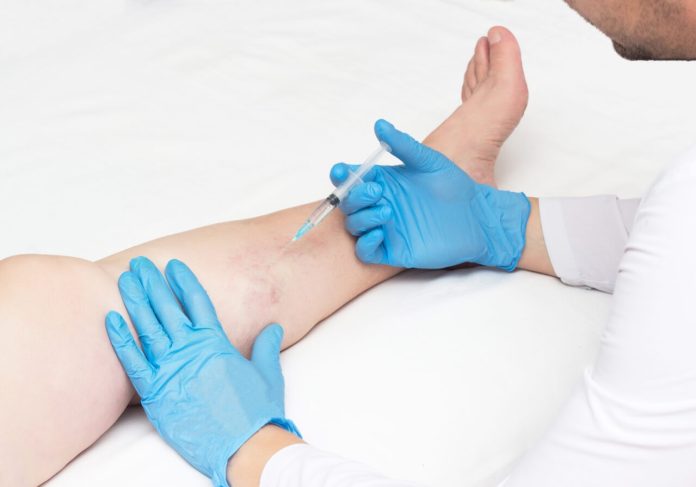California Vein Experts