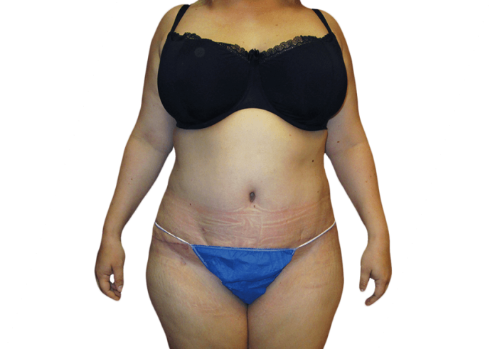 Belly Fat Removal Surgery