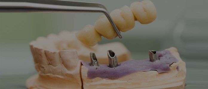 Tooth Replacement Houston Tx