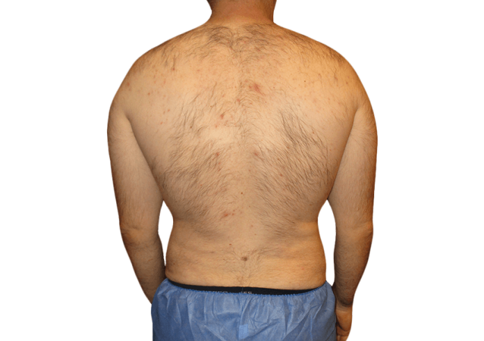 Liposuction Houston