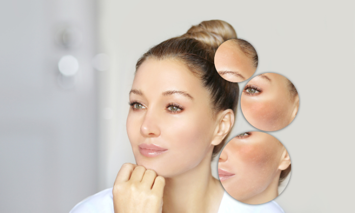 Melasma Treatment in Arlington