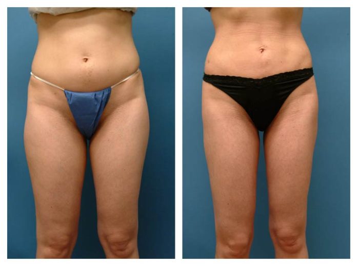 liposculpture