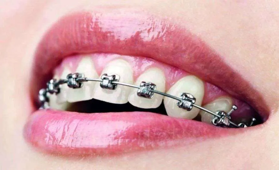 invisalign Tyldesley