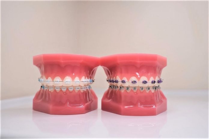 palate expander before and after