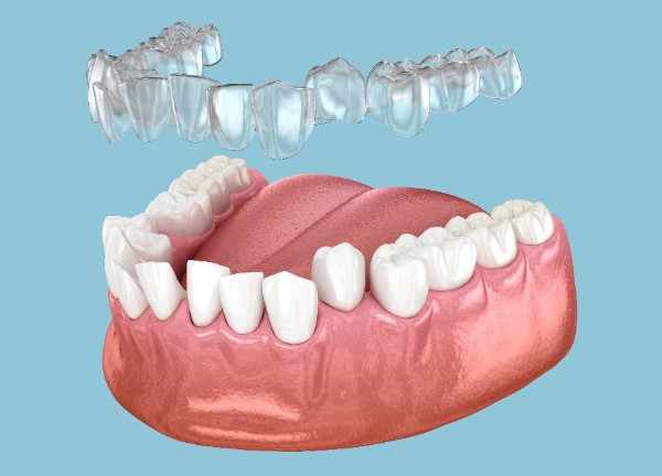 invisalign Ashford

