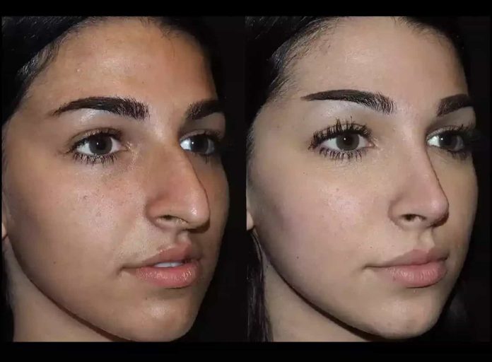 Septoplasty in Dubai