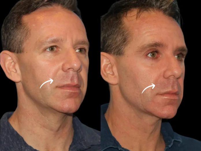 sculptra in dubai