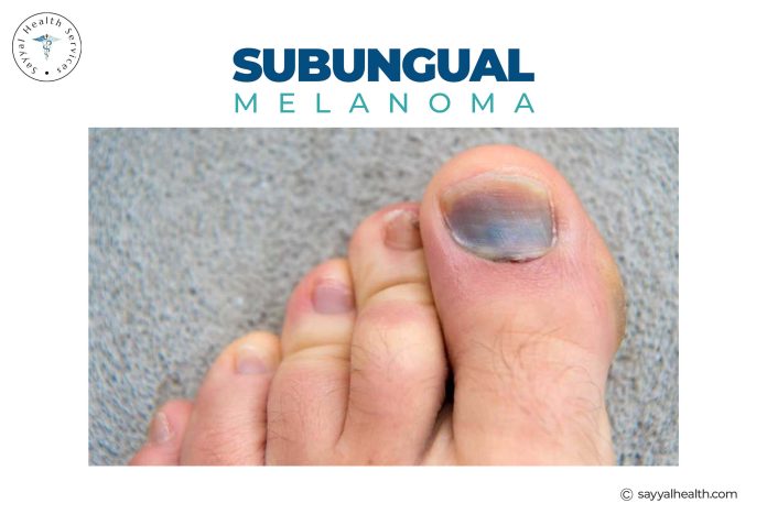 toenail melanoma