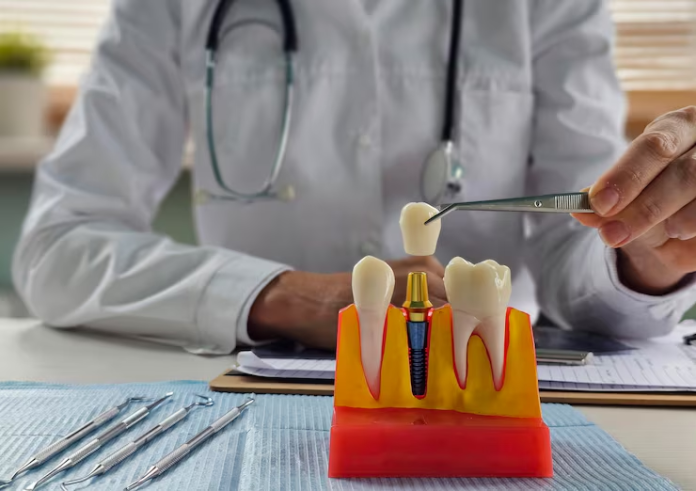 dental implants