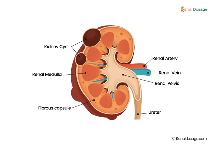 kidney cyst
