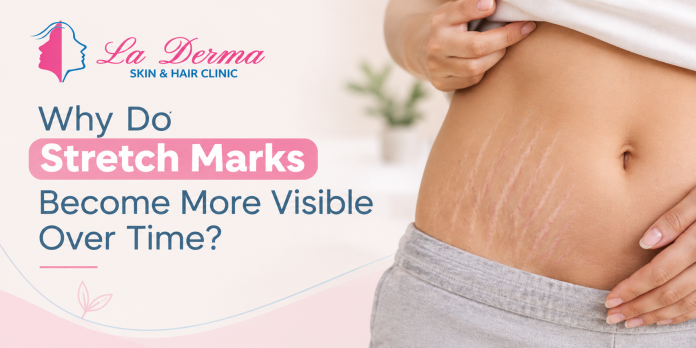 Why Do Stretch Marks Become More Visible Over Time?